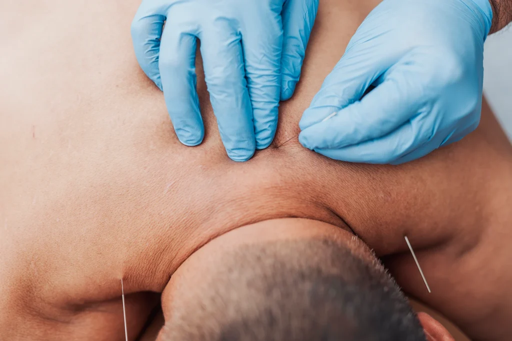 Akupunkturbehandlung im Nackenbereich eines liegenden Patienten