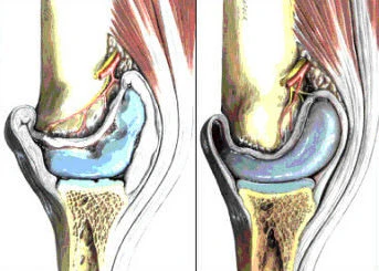 Beginnender Gelenkverschleiß des Knies bei Arthrose