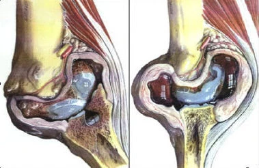 Fortgeschrittener Gelenkverschleiß des Knies bei Arthrose