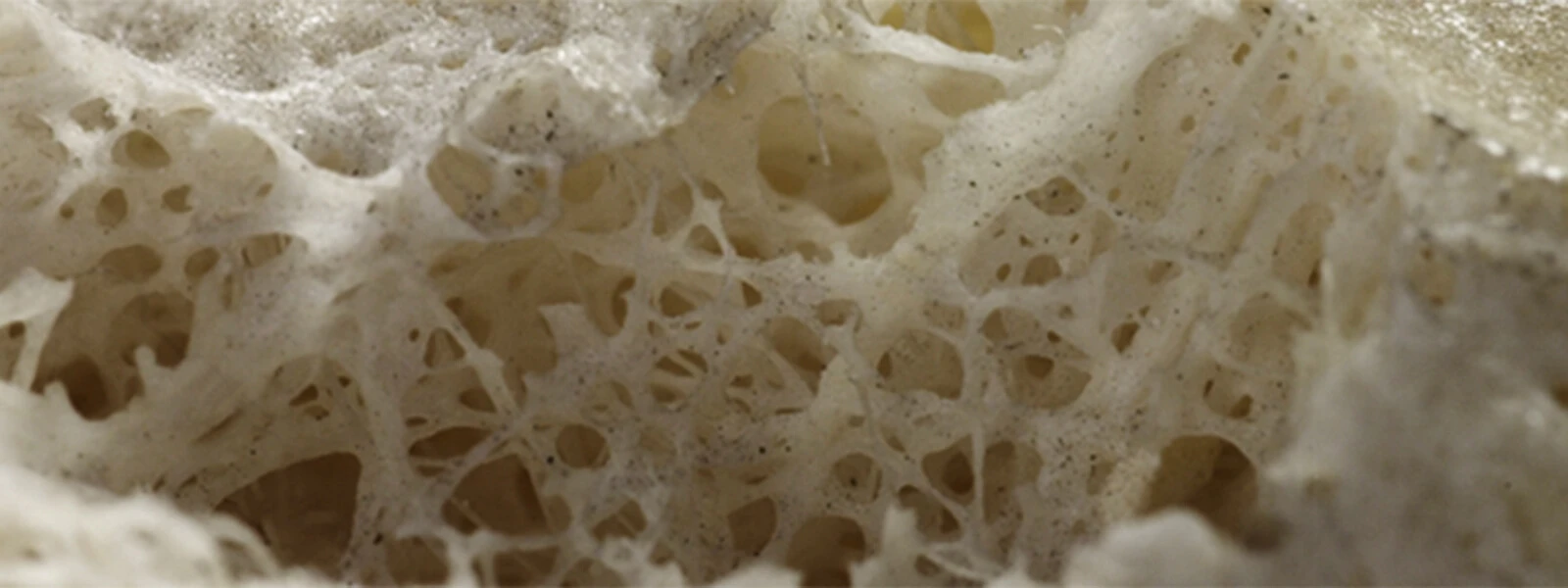 Veränderte Knochenstruktur mit verringerter Knochendichte bei Osteoporose
