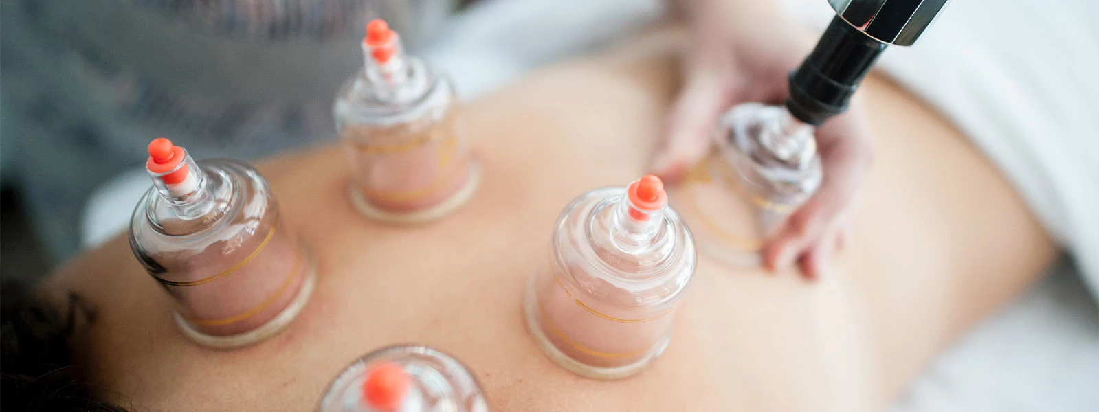 Schröpfkopfmassage am Rücken im Rahmen einer orthopädischen Behandlung